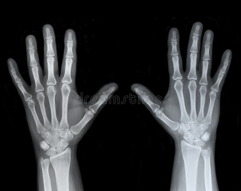 Left and Right Hand X-Ray