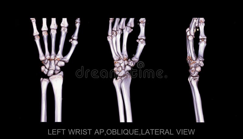 Left wrist joint 3D rendering image rotating on black background . vector illustration Left wrist joint 3D rendering image rotating on black background . vector illustration