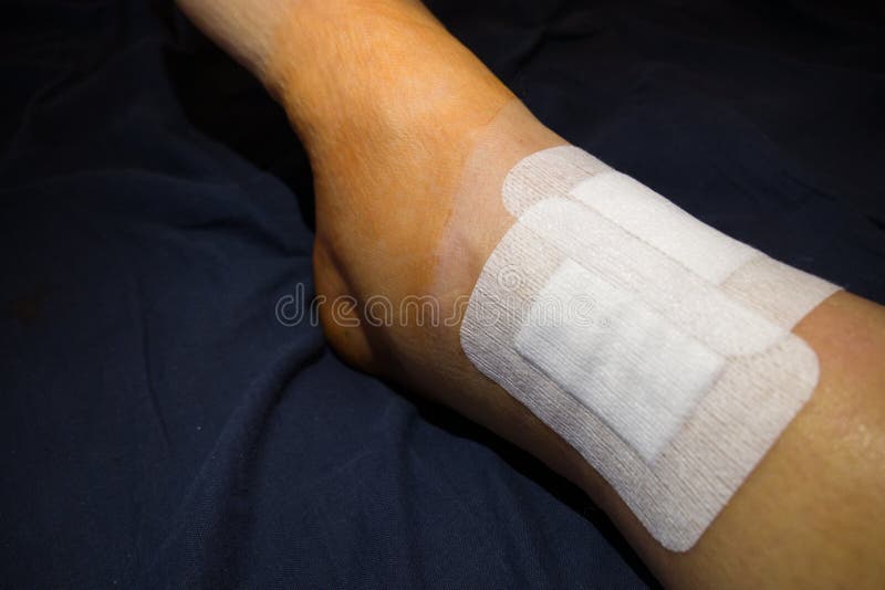 Leg in a Bandage after Surgery Stock Image Image of compression, physiotherapist 267688189