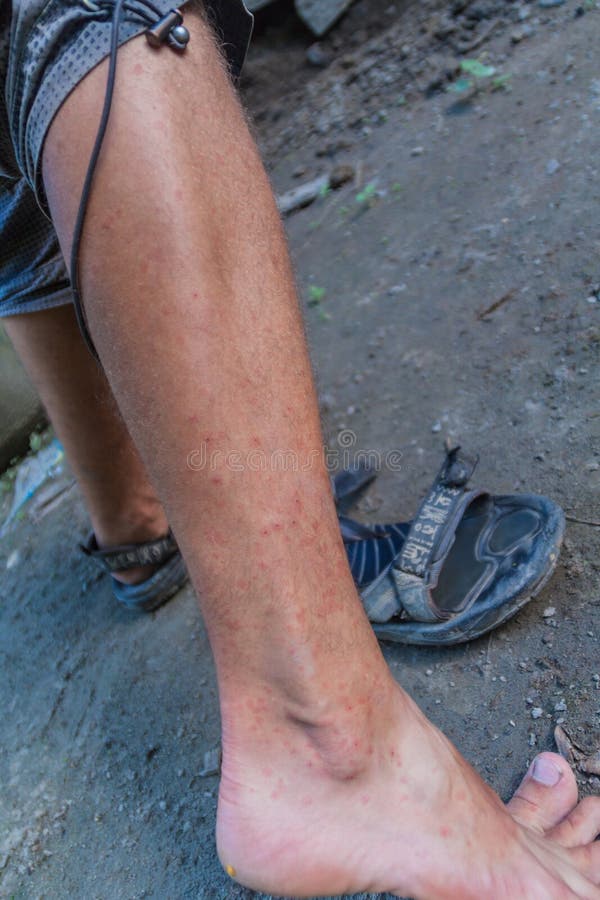 Leg Covered by the Bites of Sandflies Stock Image Image of parasitic