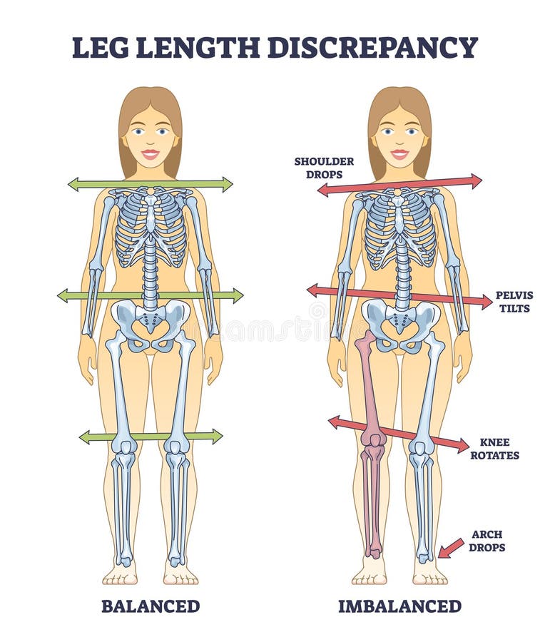 Leg length discrepancy condition with imbalanced skeleton outline diagram