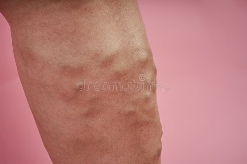 Leg Of Senior Woman With Varicose Veins On Coral Background Stock Image Image Of Massage