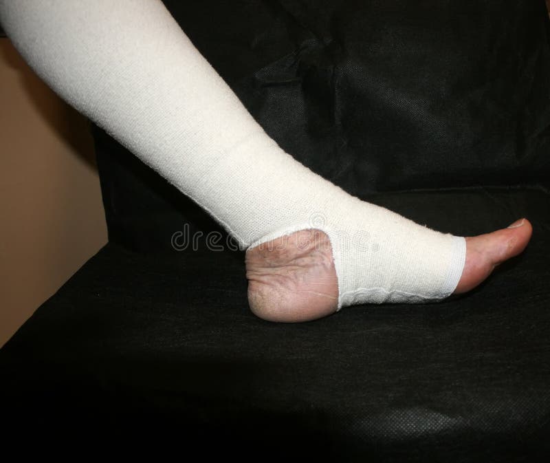 Bandaje elastice: cum să bandajezi un picior cu vene varicoase corect - recomandări