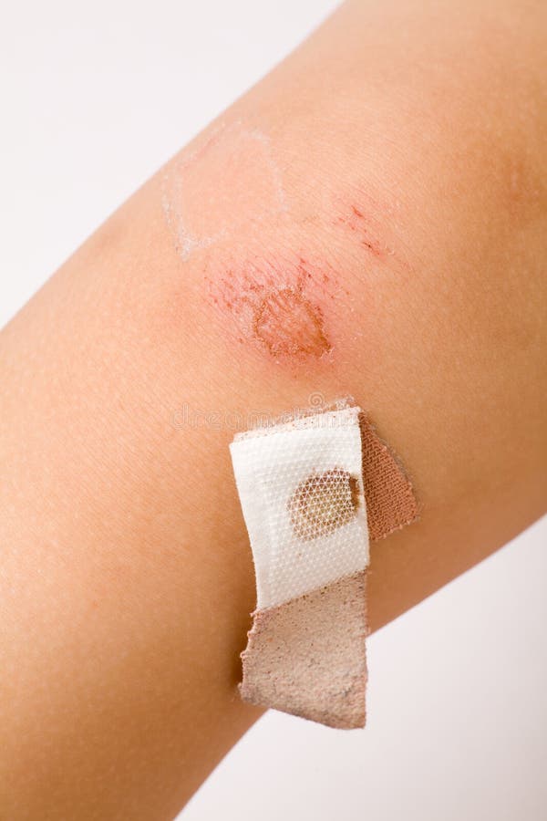 Leg Wound And Bandage Stock Photo Image Of Protection 2798622 leg-wound-and-bandage-stock-photo-image-of-protection-2798622
