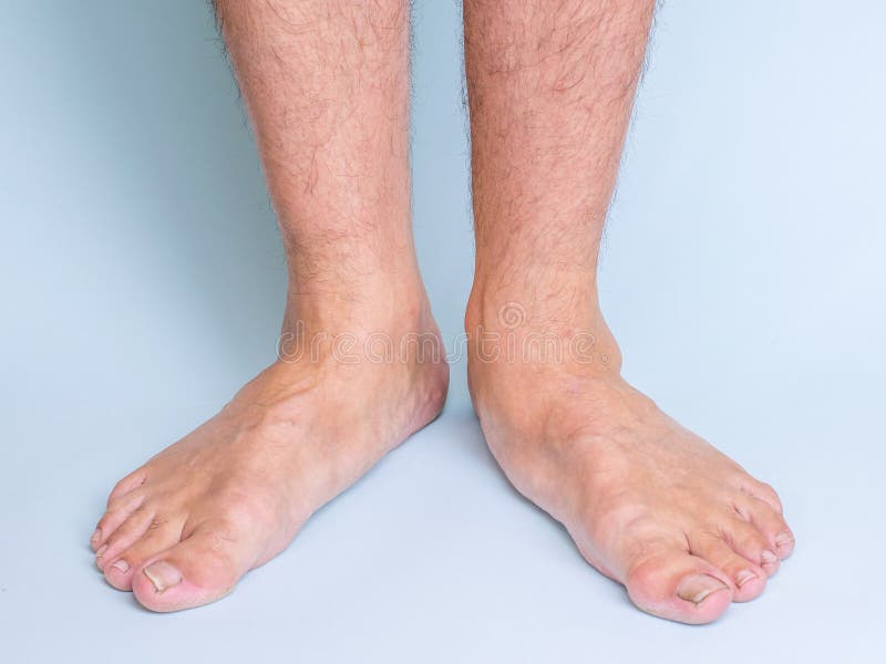 Legs of a man with a pronounced flat feet. Front view.