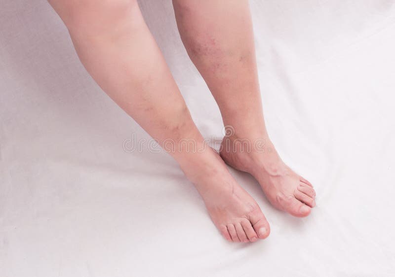 Legs of an old woman on a white background with varicose veins on the legs, phlebeurysm, anatomy