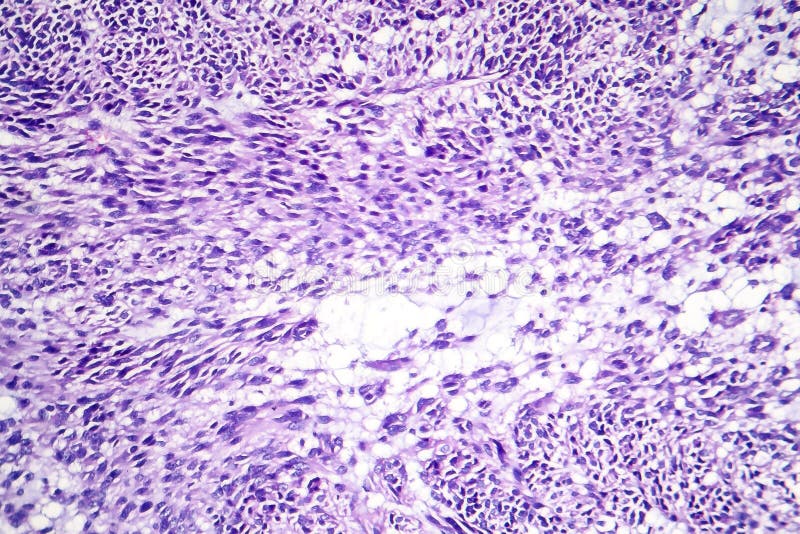 Leiomyoma eller fibroids, är en godartad tumör för slät muskel royaltyfri bild Leiomyoma eller fibroids, är en godartad tumör för slät muskel royaltyfri bild