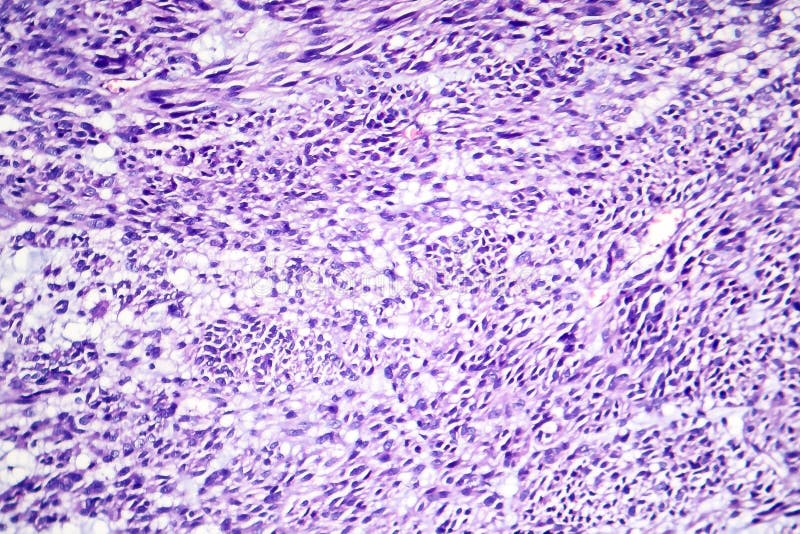 Leiomyoma, of fibroids, zijn een goedaardige vlotte spiertumor royalty-vrije stock fotografie Leiomyoma, of fibroids, zijn een goedaardige vlotte spiertumor royalty-vrije stock fotografie
