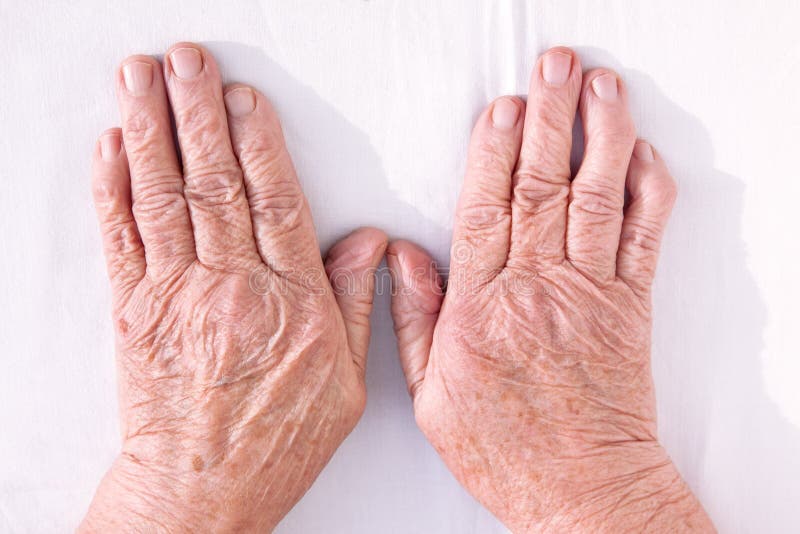 Les mains de dame âgée geformed du rhumatisme articulaire image libre de droits Les mains de dame âgée geformed du rhumatisme articulaire image libre de droits
