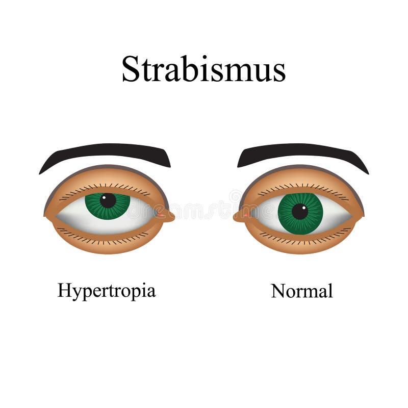 Les maladies de l'oeil - strabismus Une variation de illustration stock Les maladies de l'oeil - strabismus Une variation de illustration stock