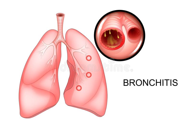 Les poumons, affectés avec la bronchite illustration de vecteur