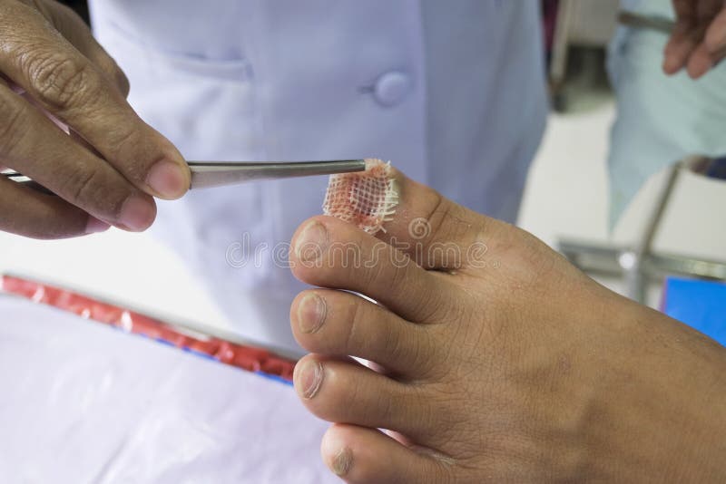 Lesion on Foot from Nail Extraction. Clean the Wound in Hospital Stock