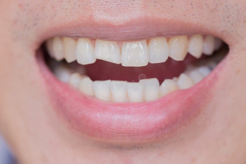 Lesiones de los dientes o dientes adaptación varón Trauma y daño del nervio del diente herido imagen de archivo Lesiones de los dientes o dientes adaptación varón Trauma y daño del nervio del diente herido imagen de archivo
