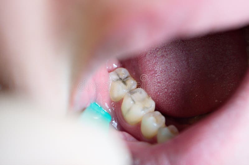 Lesioni cutanee sui denti da masticare, carie dentarie, difetti estetici