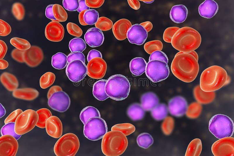 Leucemia Linfoblastica Acuta, Sbavatura Del Midollo Osseo Illustrazione
