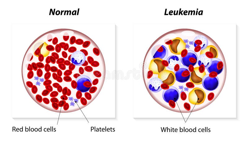 Leukemia Or Leukaemia Stock Vector Illustration Of Cardiovascular