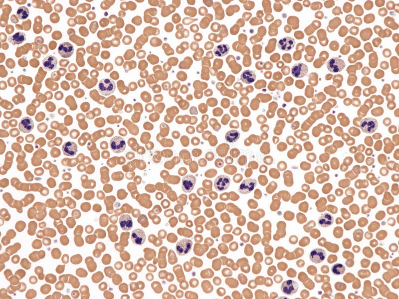 The term leukemoid reaction describes an increased white blood cell count (> 50,000 cells ?L), which is a physiological response to stress or infection (as opposed to a primary blood malignancy, such as leukemia). Peripheral blood, Wright x400. The term leukemoid reaction describes an increased white blood cell count (> 50,000 cells ?L), which is a physiological response to stress or infection (as opposed to a primary blood malignancy, such as leukemia). Peripheral blood, Wright x400.