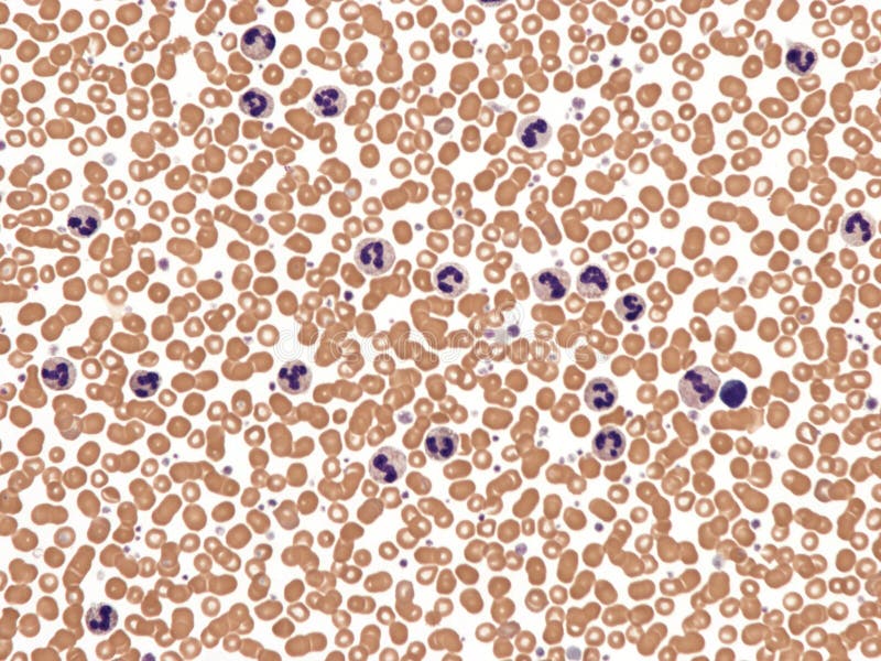 The term leukemoid reaction describes an increased white blood cell count (> 50,000 cells uL), which is a physiological response to stress or infection (as opposed to a primary blood malignancy, such as leukemia). Peripheral blood, Wright x400. The term leukemoid reaction describes an increased white blood cell count (> 50,000 cells uL), which is a physiological response to stress or infection (as opposed to a primary blood malignancy, such as leukemia). Peripheral blood, Wright x400.