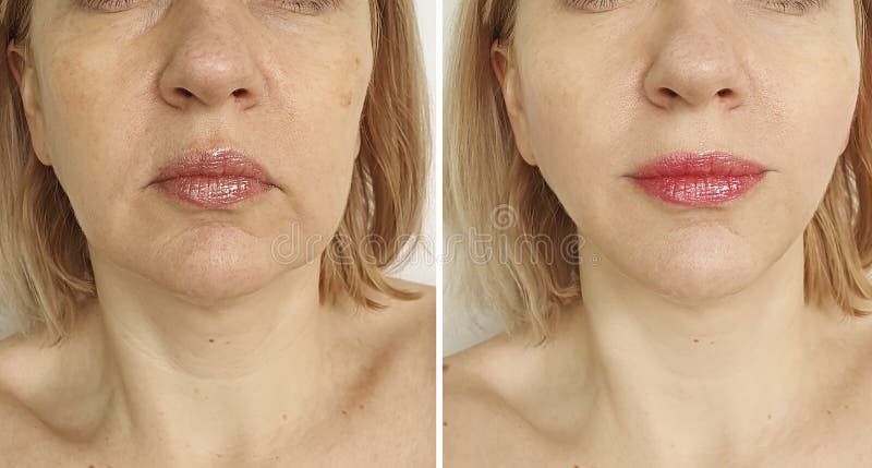 Levantamento da face feminina antes e depois do tratamento de plástico
