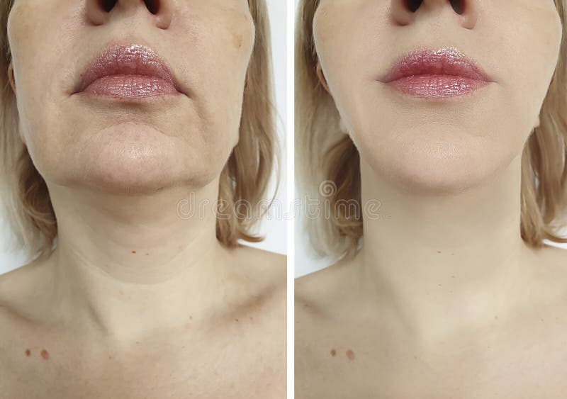 Levantamento da face da mulher antes e depois do tratamento