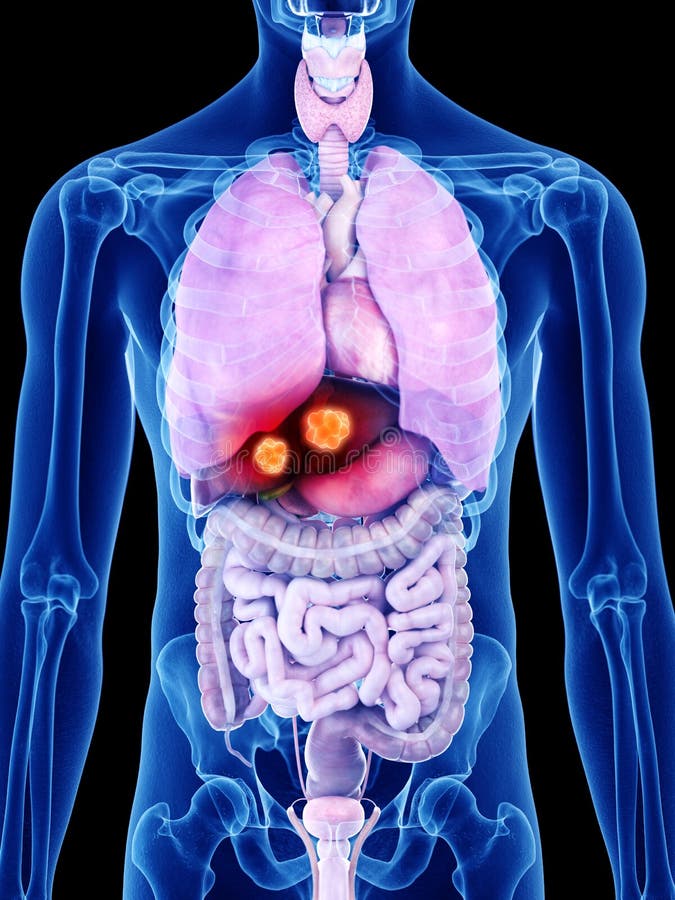 Levercancer royaltyfri illustrationer Levercancer royaltyfri illustrationer