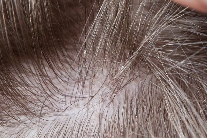 Lice in Blonde Hair How To Spot Lice In Blonde Hair Signs Prevention  And Best Treatment  Curvy Girl Journal