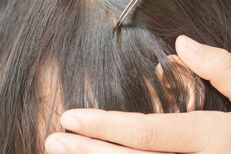 487 Hair Lice Louse Stock Photos - Free & Royalty-Free Stock Photos from Dreamstime 487 Hair Lice Louse Stock Photos - Free & Royalty-Free Stock Photos from Dreamstime