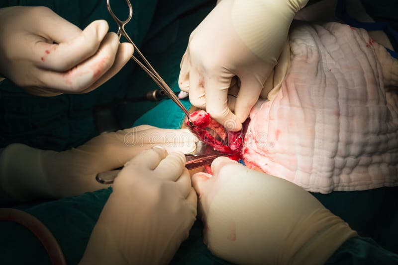 The ligation appendix for appendectomy