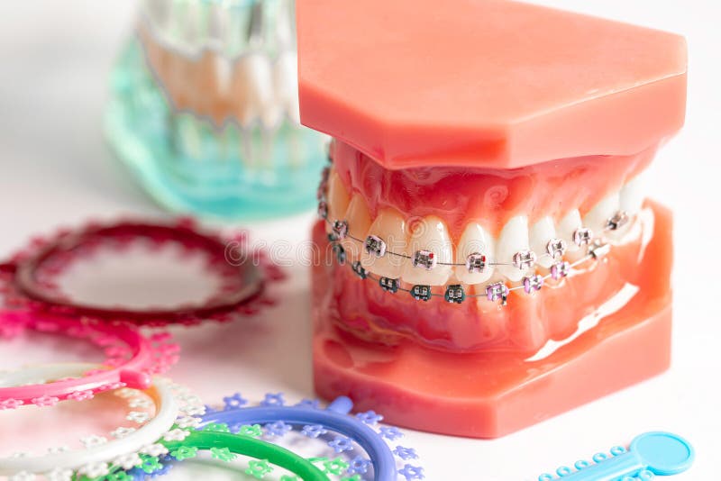 Élastiques Orthodontiques,300 Bandes En Caoutchouc Dentaire,Bracele