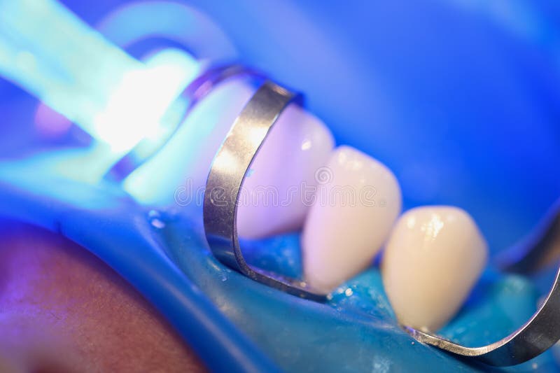 Light Falling on Teeth during Installation of Veneers in Dental Clinic