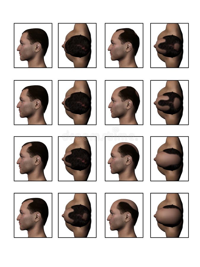 Receding Hairline Balding Losing Hair High Quality 3D Image. Receding Hairline Balding Losing Hair High Quality 3D Image