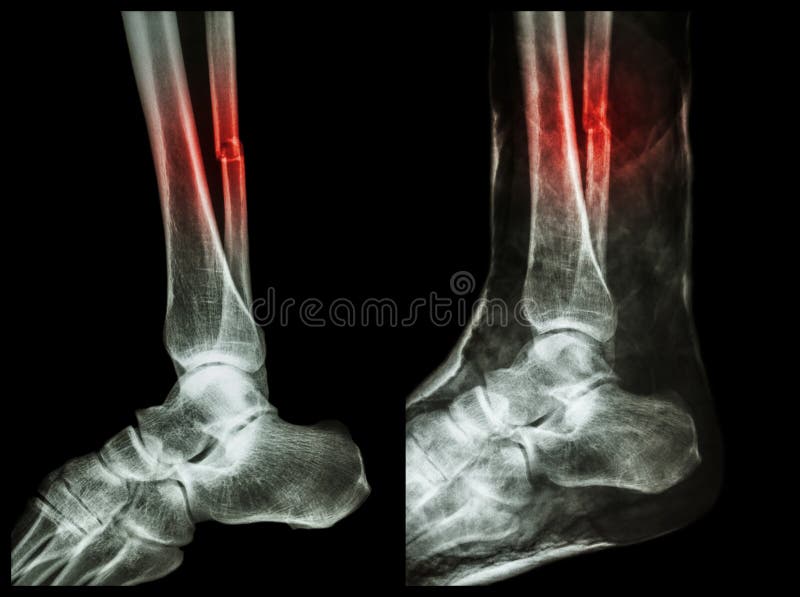 Linkerbeeld: Breukschacht van fibula (kalfsbeen), Juist beeld: Het was splinted met gipsverband