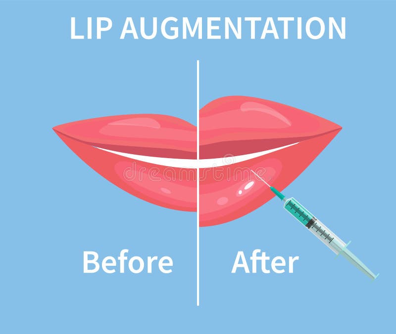 Lip Augmentation. before and after Lip Filler Injections. Vector ...