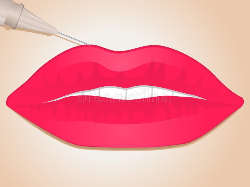 Lip filler injection stock vector. Illustration of enhancement 20900060