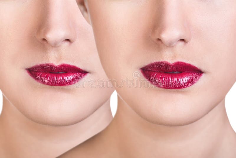 Before and after lip filler injections.