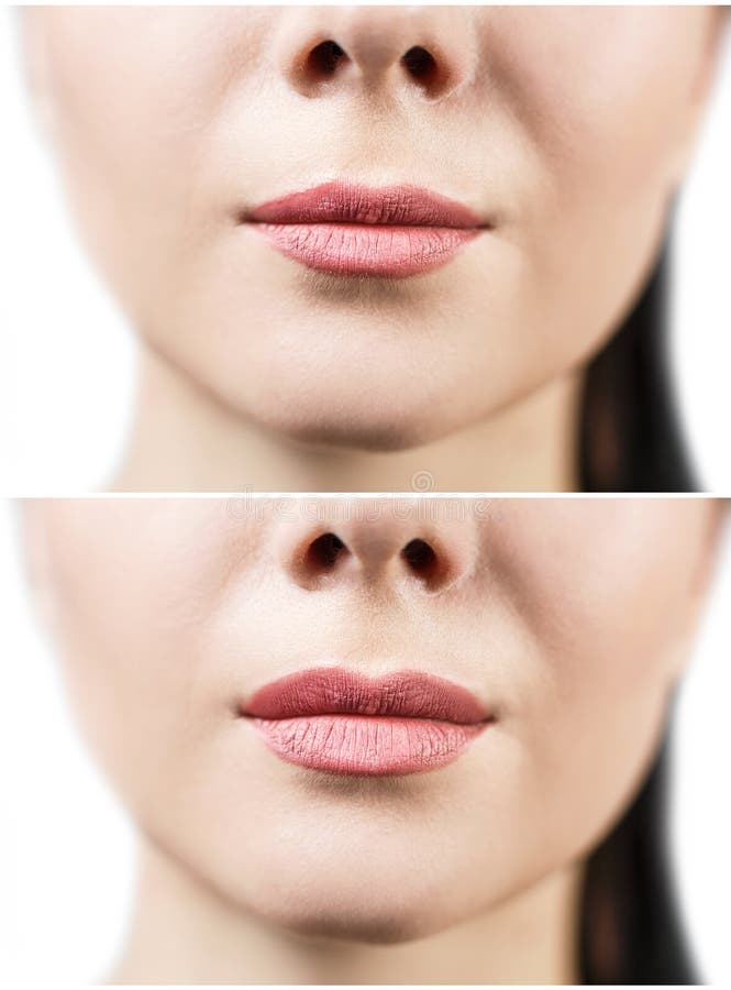 Before and after Lip Filler Injections. Stock Image Image of