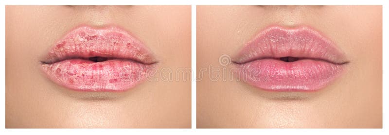 136 Chapped Dry Lips Stock Photos - Free & Royalty-Free Stock Photos from Dreamstime