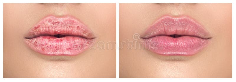 136 Chapped Dry Lips Stock Photos - Free & Royalty-Free Stock Photos from  Dreamstime