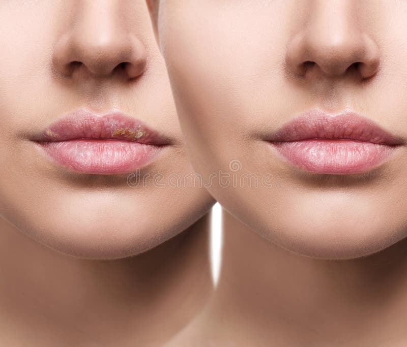 Lips with Herpes before and after Treatment. Stock Image Image of