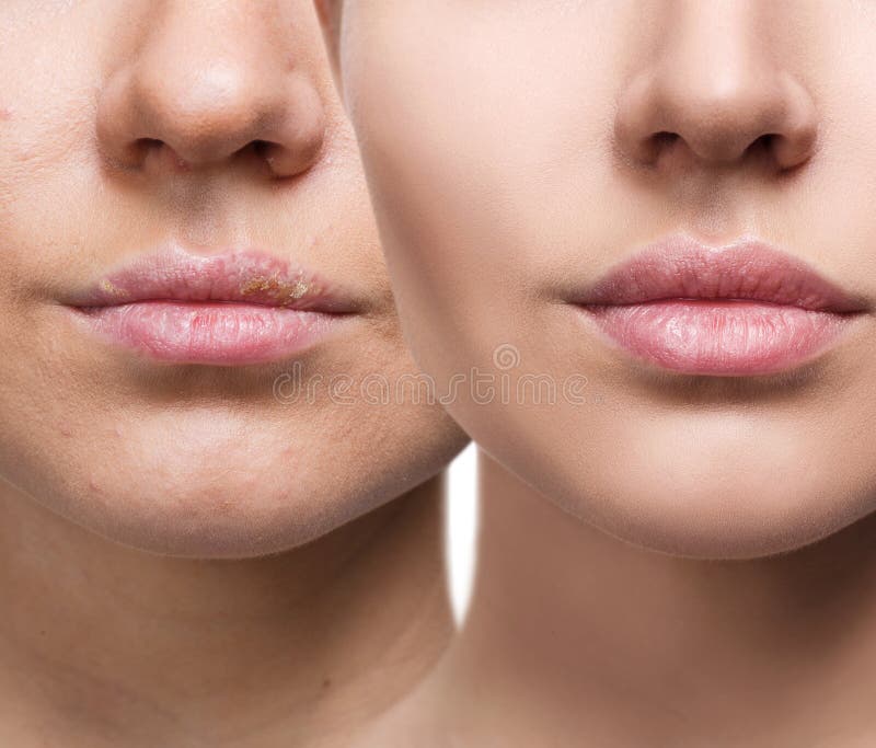 Lips with Herpes before and after Treatment. Stock Photo Image of