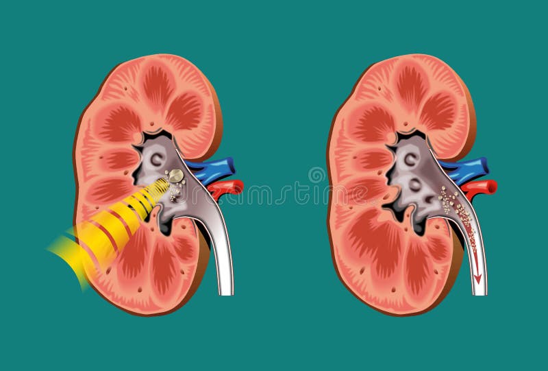 Lithotripsy in kidney stones royalty free illustration