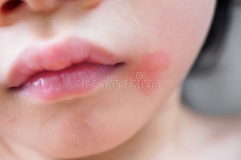 Severe Eczema Skin Rash And Allergic Reaction Symtom At Child Body