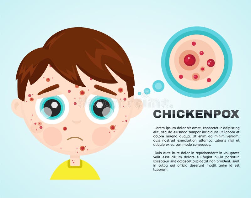Little Boy Kid Face Sick Chickenpox Stock Vector - Illustration of biology,  pain: 100663424