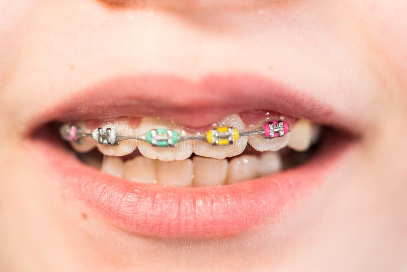 Little Girl with Rainbow Braces Stock Photo - Image of caucasian ...