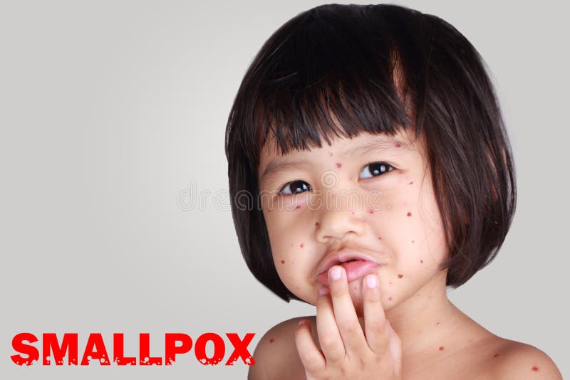 Little Girl With Smallpox royalty free stock images