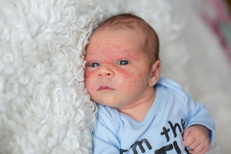 622 Baby Eczema Photos Free Royalty Free Stock Photos From Dreamstime