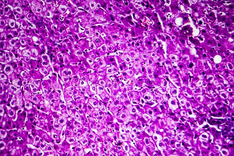 Liver Edema, Light Micrograph Stock Photo Image of edema