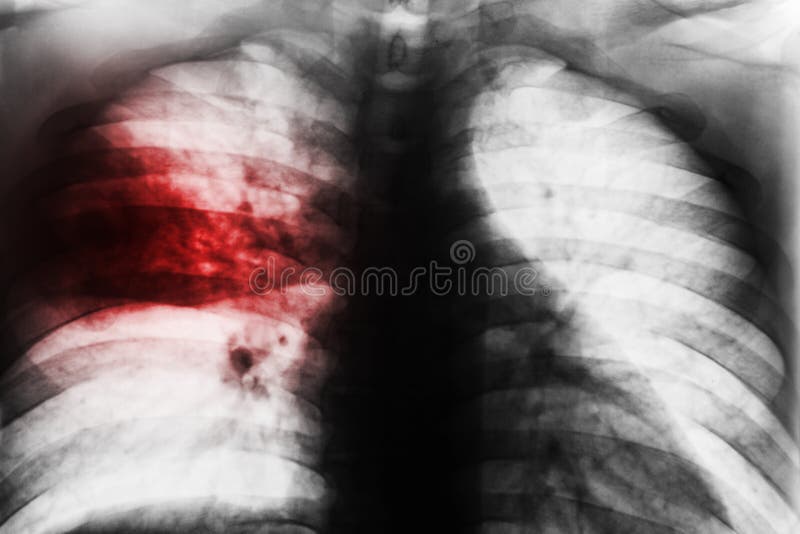 Lobar Pneumonia. Film chest x-ray show patchy infiltrate at right middle lung from Mycobacterium tuberculosis infection & x28; Pulmonary tuberculosis & x29 stock photography