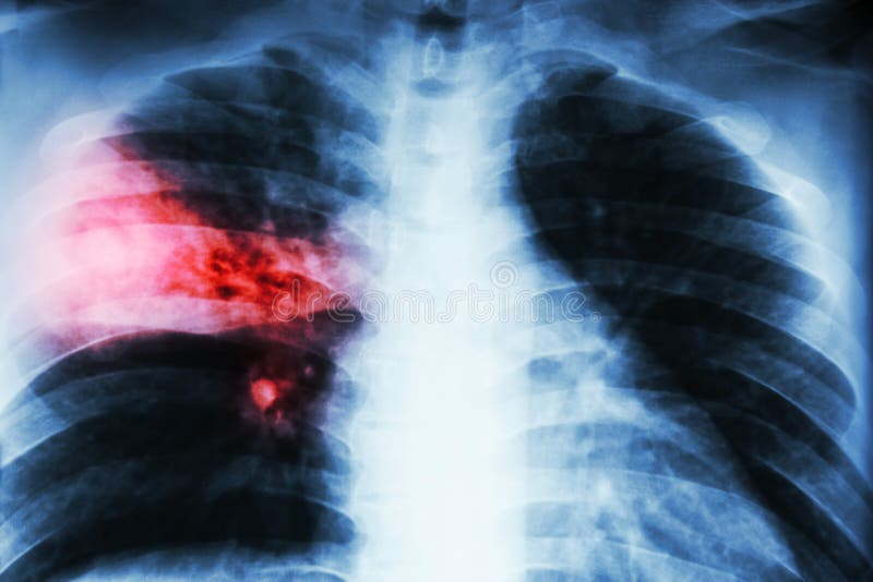 Lobarpneumonie alveolare Infiltration der FilmBrustradiographie-Show am rechten mittleren Vorsprung wegen der Tuberkuloseinfektio lizenzfreie stockfotos Lobarpneumonie alveolare Infiltration der FilmBrustradiographie-Show am rechten mittleren Vorsprung wegen der Tuberkuloseinfektio lizenzfreie stockfotos