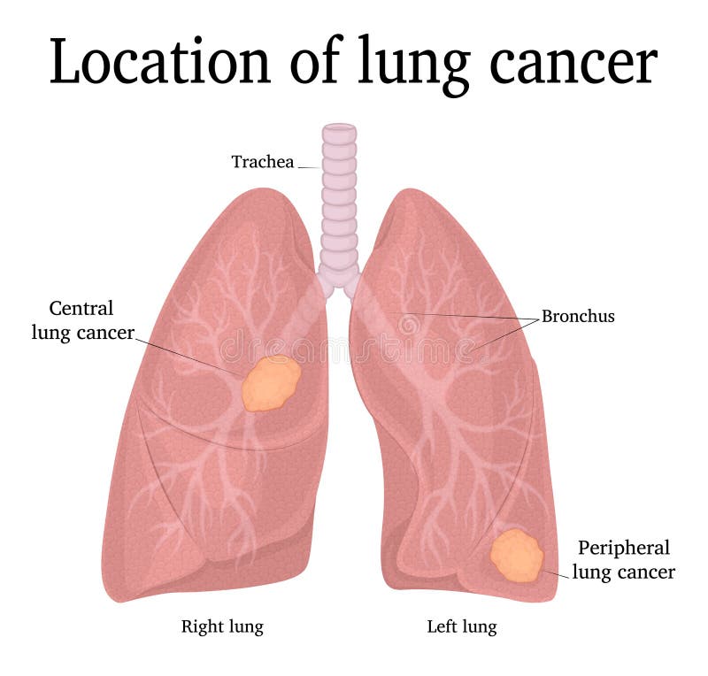 Location of lung cancer stock vector. Illustration of development ...